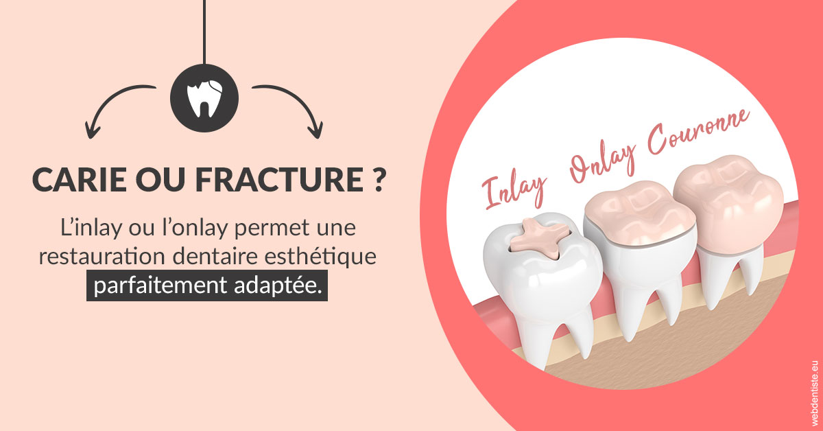 https://selarl-sabban.chirurgiens-dentistes.fr/T2 2023 - Carie ou fracture 2