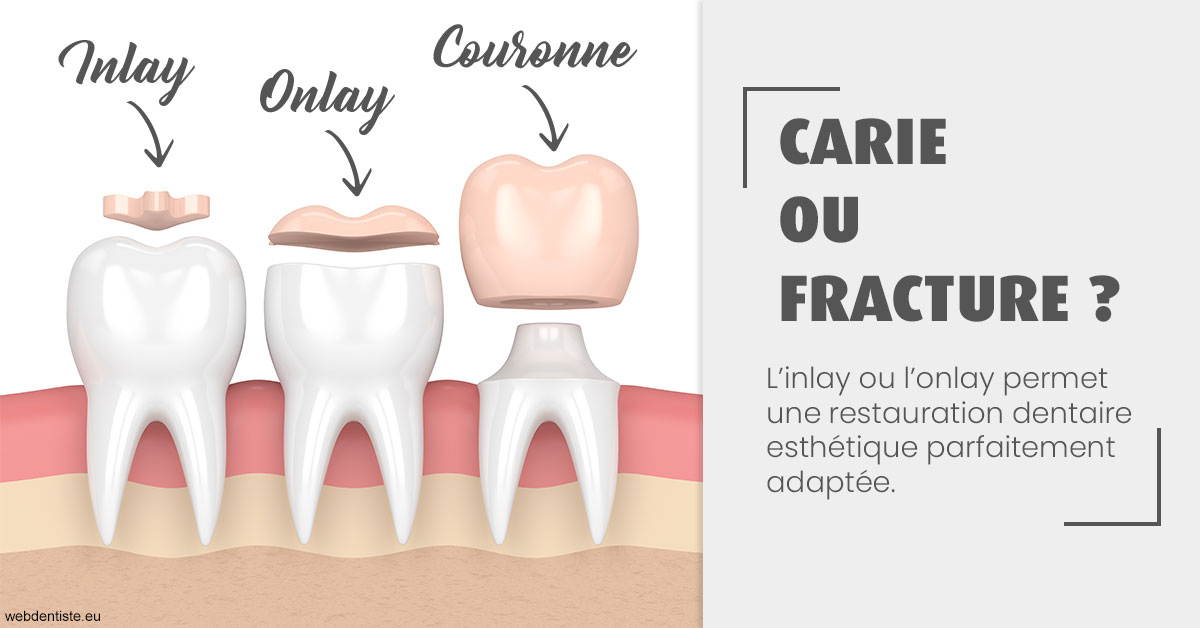 https://selarl-sabban.chirurgiens-dentistes.fr/T2 2023 - Carie ou fracture 1