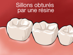 Protéger les dents définitives grâce aux scellements de sillons