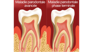Les parodontites (déchaussement des dents)