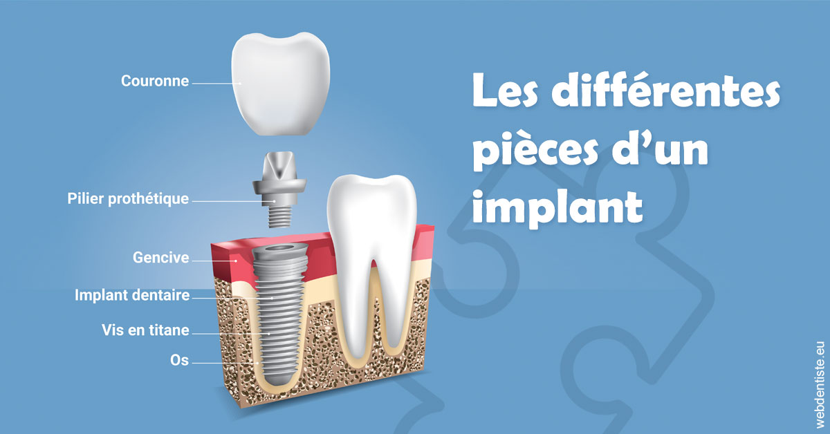 https://selarl-sabban.chirurgiens-dentistes.fr/Les différentes pièces d’un implant 1